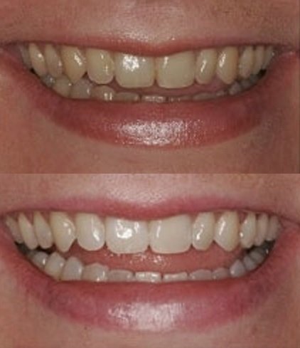 ProDental moldable whitening trays provide precise, comfortable whitening fit