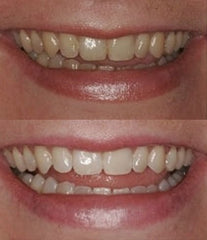 ProDental moldable whitening trays provide precise, comfortable whitening fit