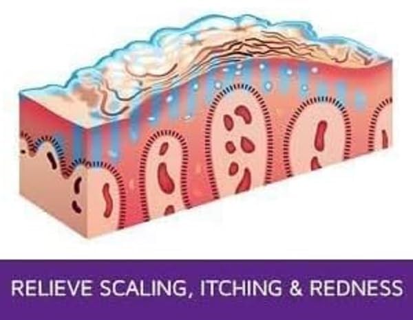 Prosoria packaging box with 2oz tube and steroid-free claim