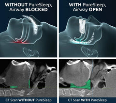 PureSleep two-component mechanism - low-profile, secure fit
