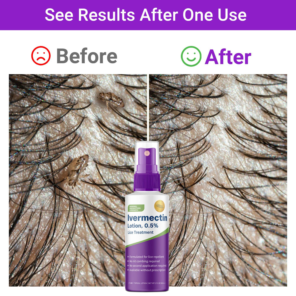 QIFEISHANKA Ivermectin Lotion spread across scalp for full coverage.
