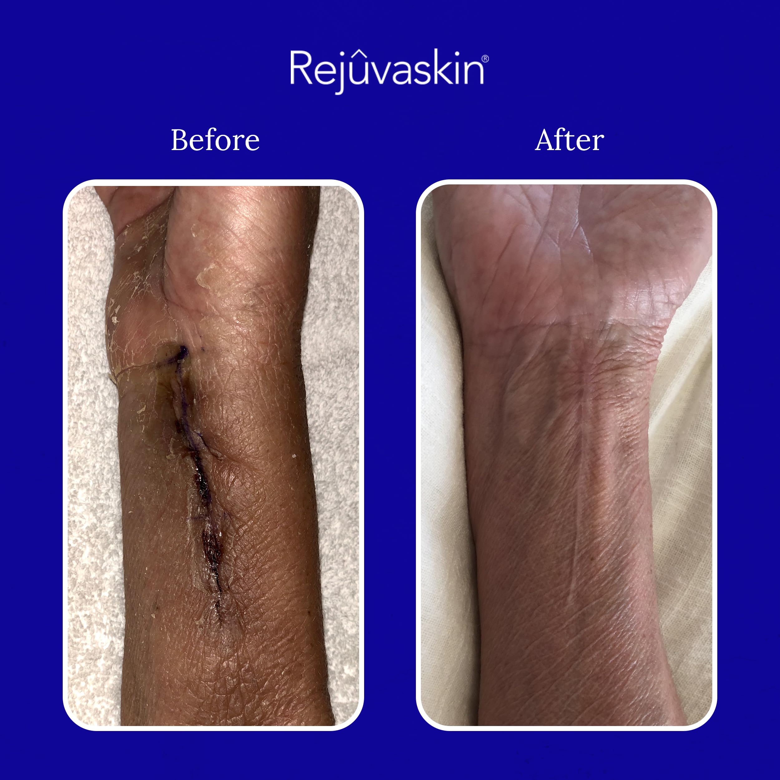 Close‑up of scar texture softening with product use