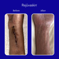 Close‑up of scar texture softening with product use