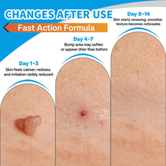 SHUNNIUB molluscum cream packaging highlighting natural ingredients