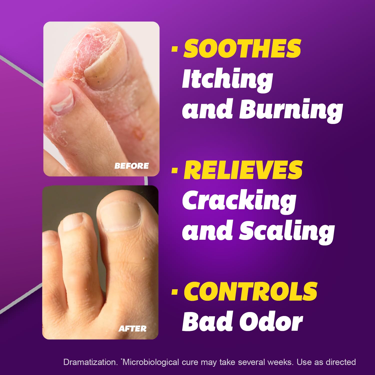 Silka cream between toes application demonstrates interdigital treatment.