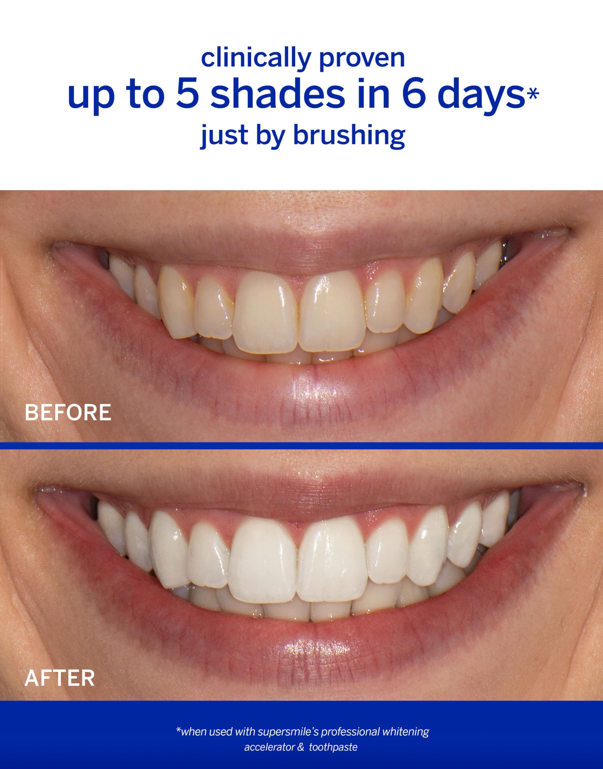 Supersmile Professional Whitening Accelerator application close-up targets stain removal
