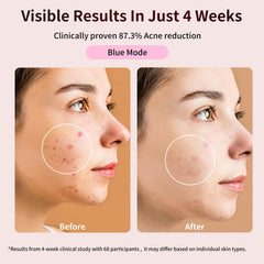 TOFEKIA flexible mask contouring to the face for even light coverage.