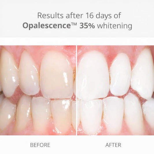 Ultradent Opalescence melon-flavor syringe for comfortable whitening sessions.