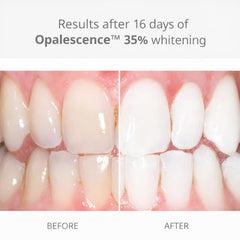 Ultradent Opalescence melon-flavor whitening syringes with smooth gel delivery.