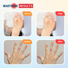 Warticide ten-percent salicylic acid label highlights strong wart care formulation.
