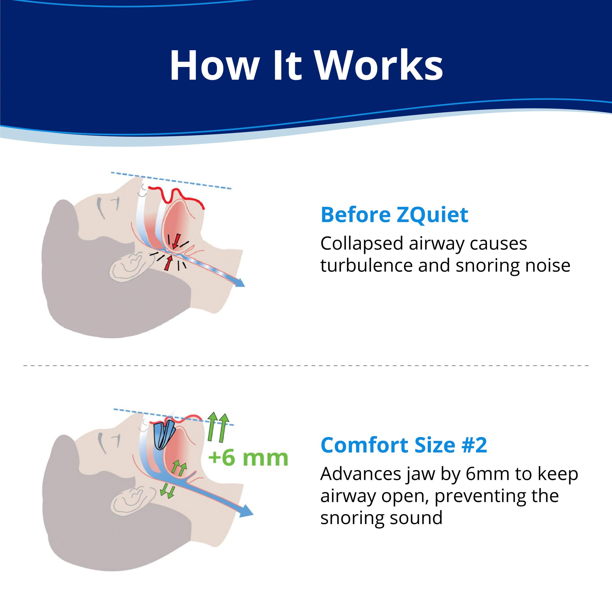 ZQuiet size 2 side profile shows jaw-forward design for snoring relief